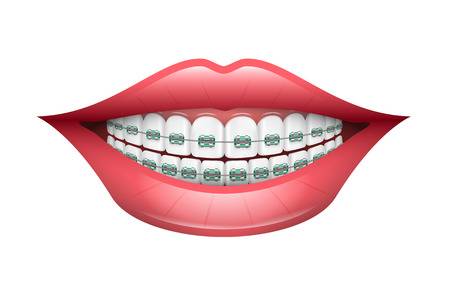 Teeth alignment 2 Best dentist vadodara, India