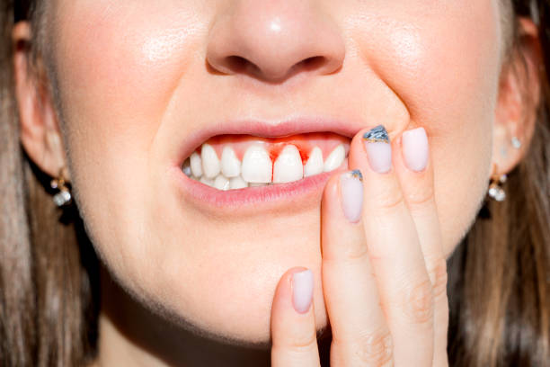 How To Tell If You Have Gum Disease Esthetica