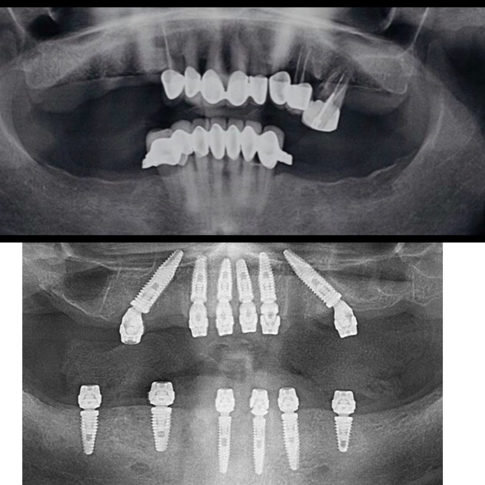 Zygoma implant treatment Vadodara, India 2022