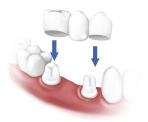 Dental Bridges or Fixed teeth bridge, Vadodara(India)