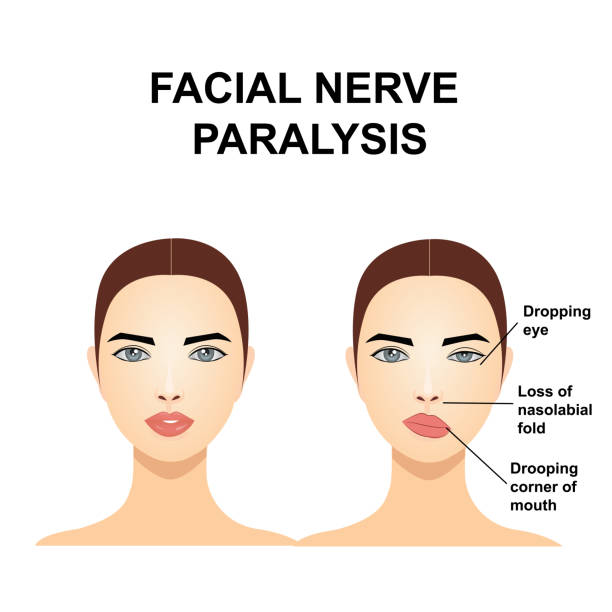 facial nerve palsy treatment