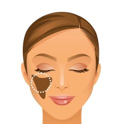 Chemical Peel Esthetica Dental Clinic November 2025 Vadodara India