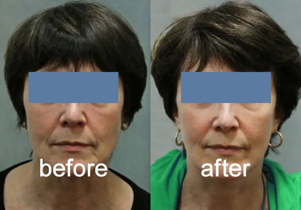 before after facelift 1 November 2025 Vadodara India