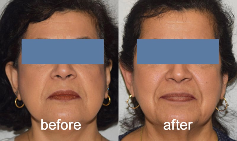 before after facelift November 2025 Vadodara India