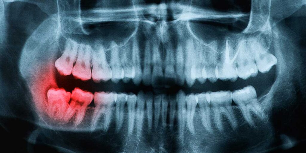 Dentoalveolar Surgery 1 Dentoalveolar Surger October 2025 Vadodara India