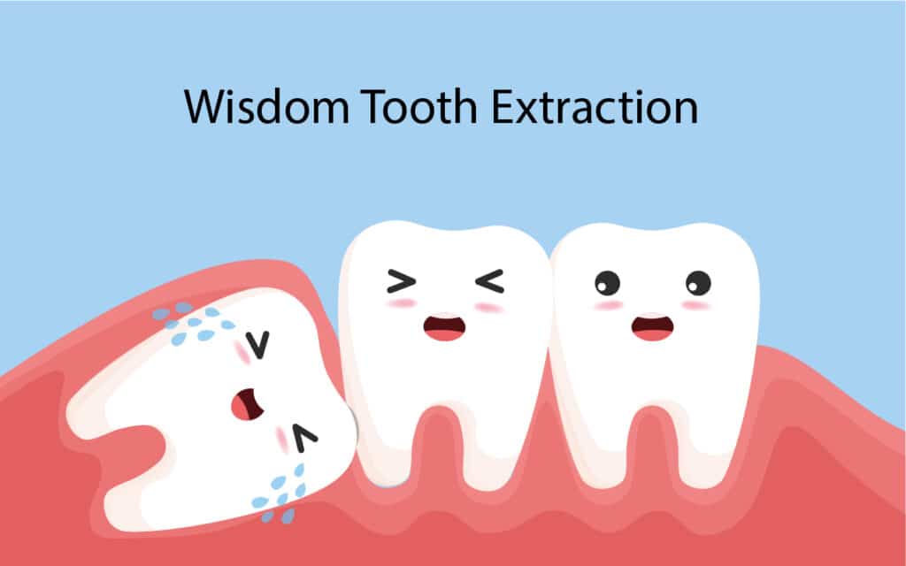 Wisdom Tooth Removal 1 Wisdom Tooth Extraction in Vadodara