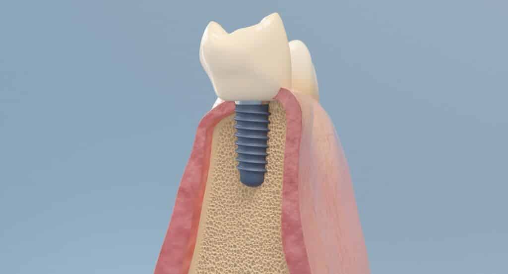Types of Dental Implants - Complete Guide 3 ShotImageImplant.04.jpg39E29BB3 88B3 49F7 BE83 9AFCC044FCB3Default October 2025 Vadodara India