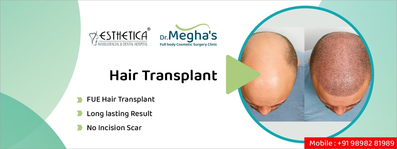 best hair transplant in Vadodara