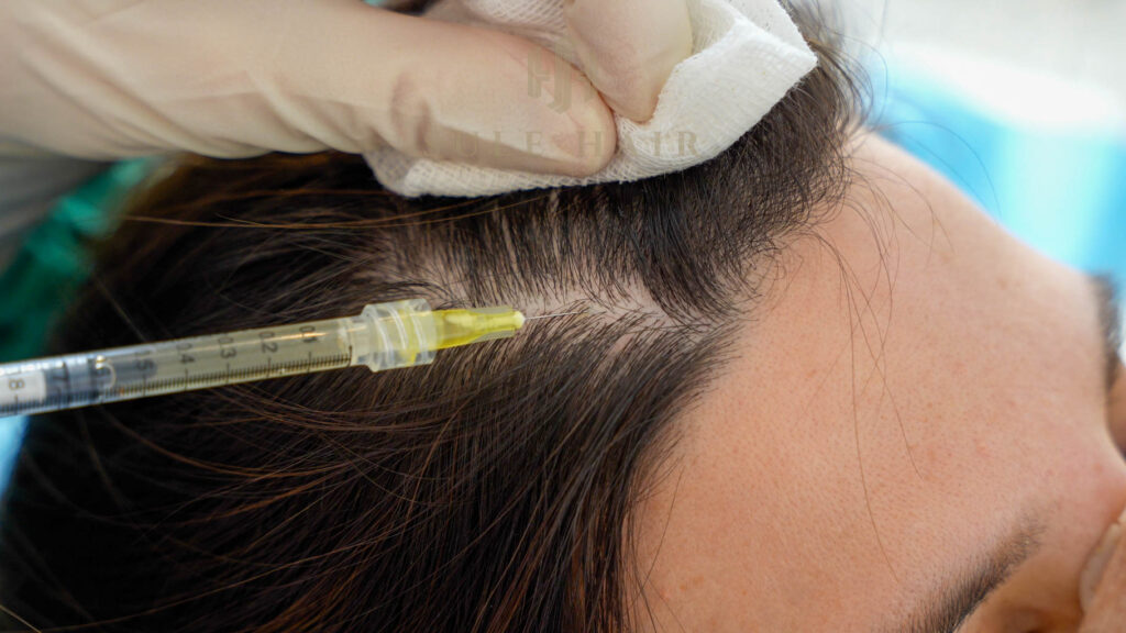 How Effective is Stem Cell Hair Transplant? A Detailed Review 10 hair October 2025 Vadodara India