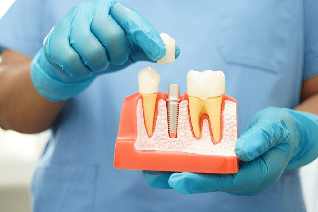 The Complete Guide to Dental Implants: What They Are and How They Can Transform Your Smile 6 dental impalnts October 2025 Vadodara India