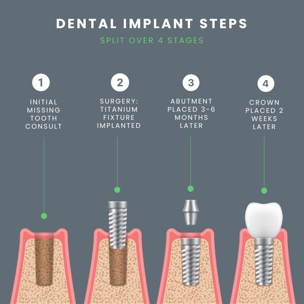 HCT Dental Clinic 3 dental implant steps 1 October 2025 Vadodara India