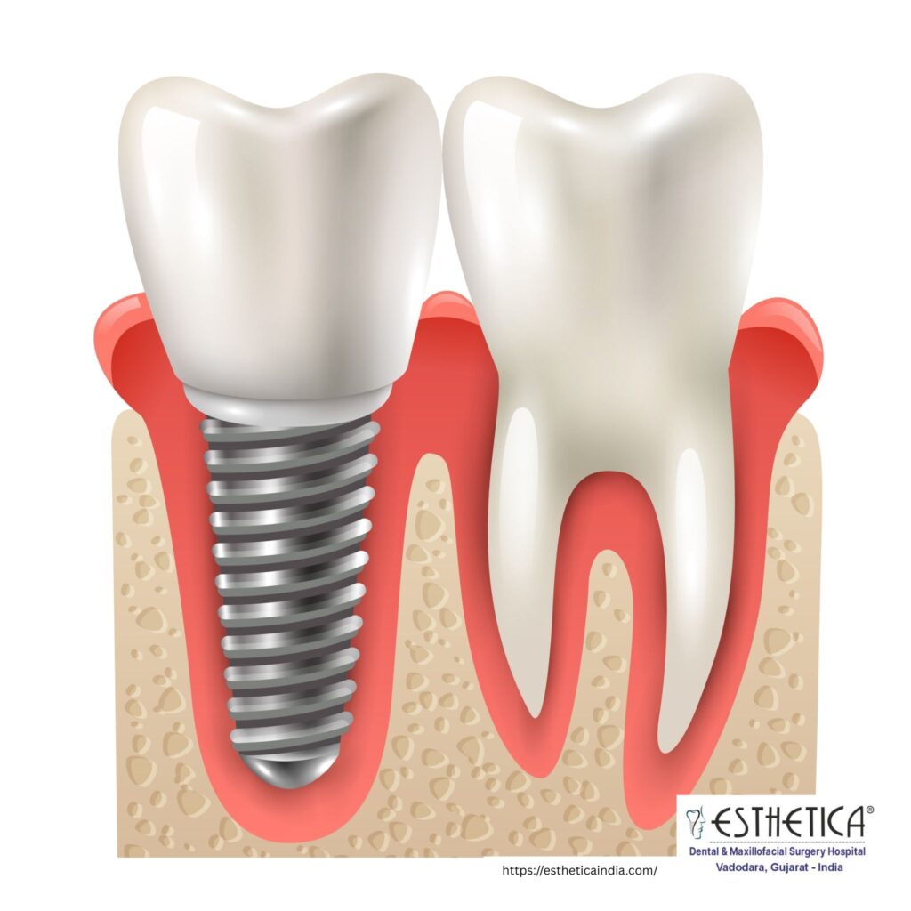Dental implants
