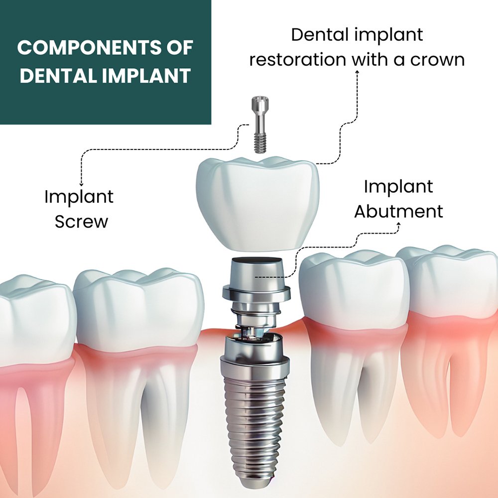 components of dental implant March 2026 Vadodara India