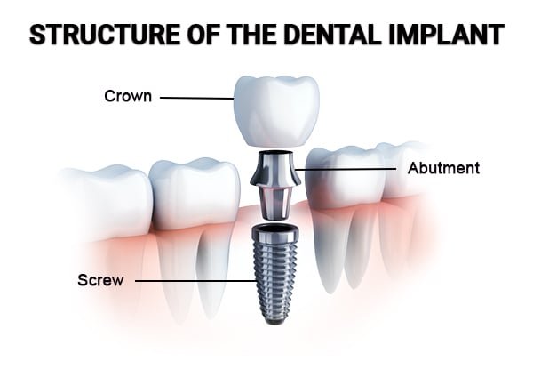 Dental implants