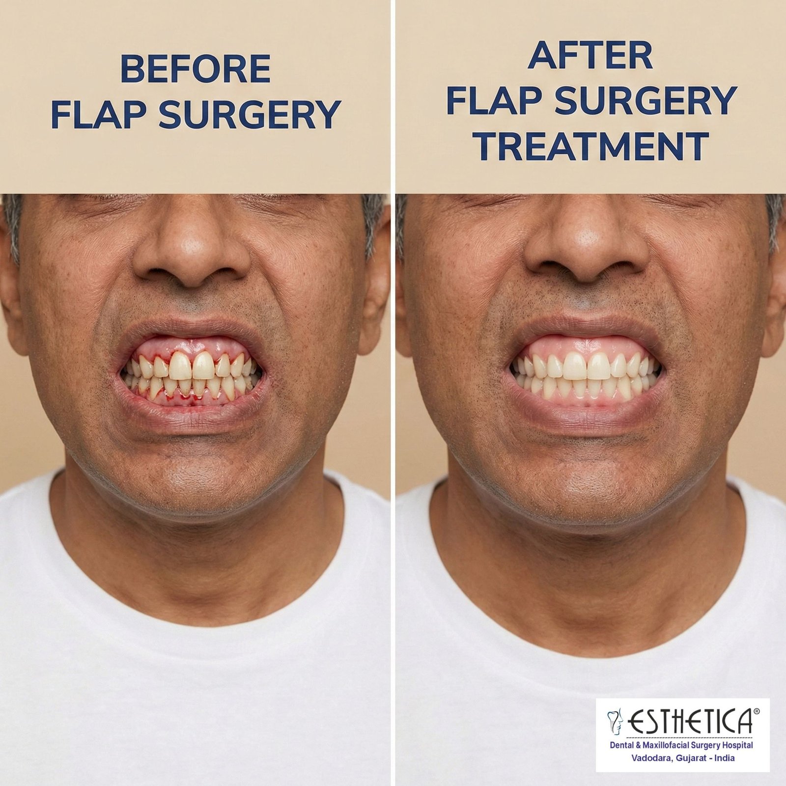 Flap surgery for teeth